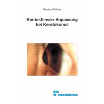 Kontaktlinsenanpassung bei Keratokonus